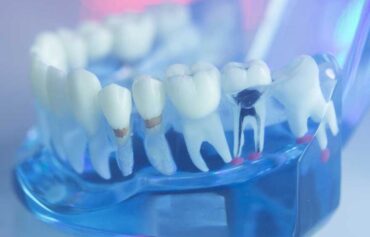 Root Canal Therapy in Mississauga