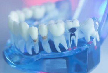 Root Canal Therapy in Mississauga