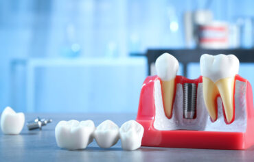 Dental Implant in Mississauga