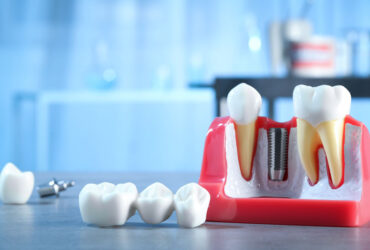 Dental Implant in Mississauga