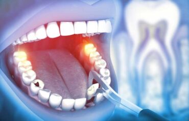 Tooth Extractions in Mississauga