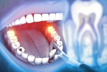 Tooth Extractions in Mississauga