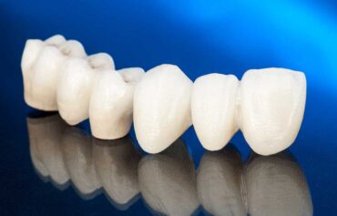 Dental Crowns in Mississauga