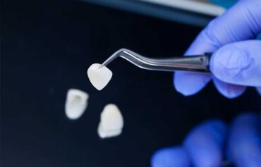 Porcelain Veneers in Mississauga