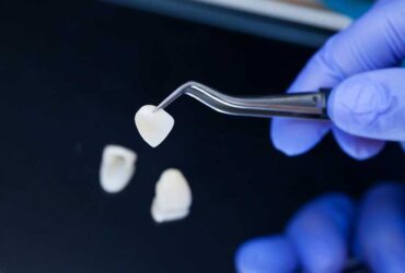 Porcelain Veneers in Mississauga